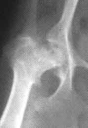 Legg-Perthes; showing necrotic femoral head