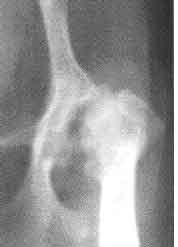 Legg-Perthes necrosis with HD