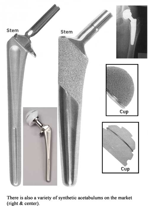 There is also a variety of synthetic acetabulums on the market (right & center).