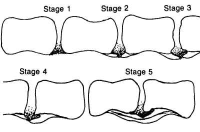 Spondylosis